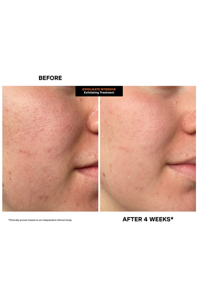 Jumbo ExfoliKate® Intensive Exfoliating Treatment $165 Value, Alternate, color, NONE