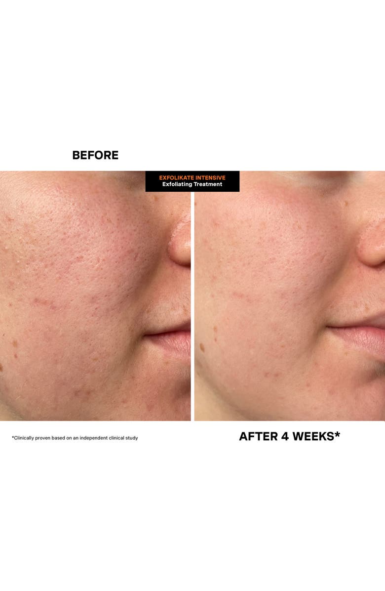 Kate Somerville<sup>®</sup> Exfolikate<sup>®</sup> Intensive Exfoliating Treatment Duo (Nordstrom Exclusive) $158 Value, Alternate, color,