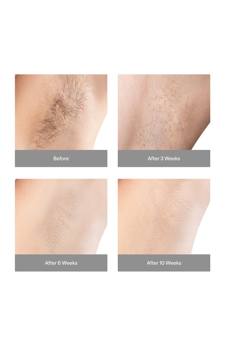 ULIKE Air3 IPL Hair Removal Device, Alternate, color, 