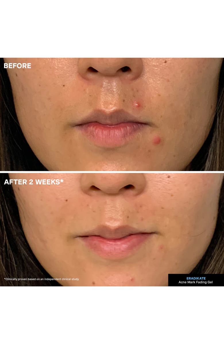 Kate Somerville<sup>®</sup> EradiKate<sup>®</sup> Acne Mark Fading Gel, Alternate, color,