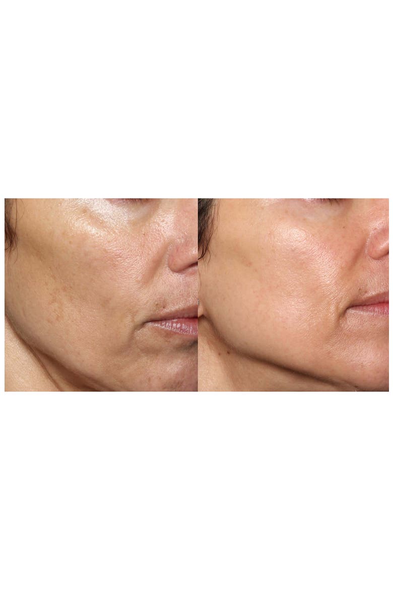 FaceFX™ Anti-Aging Device, Alternate, color, NO COLOR