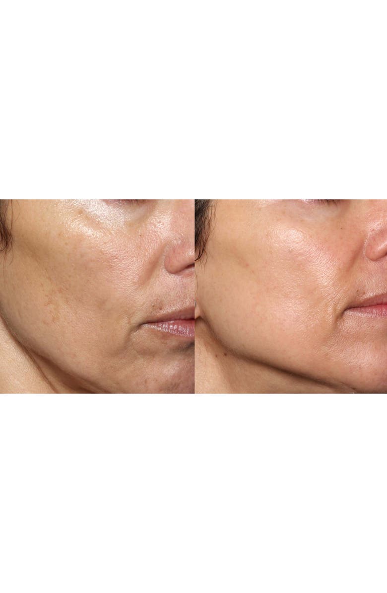 Silk'n FaceFX<sup>™</sup> Anti-Aging Device, Alternate, color, 