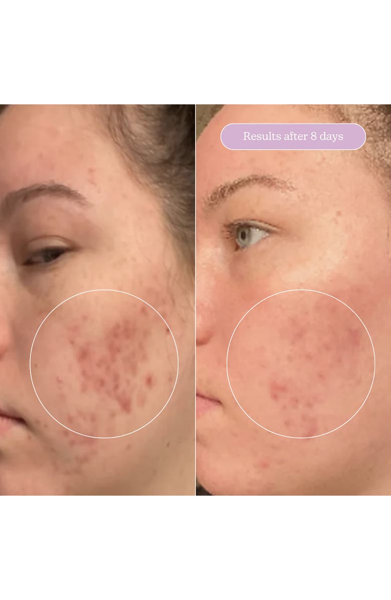 BLUME Milky Fade Spot & Scar Fade Serum, Alternate, color, 