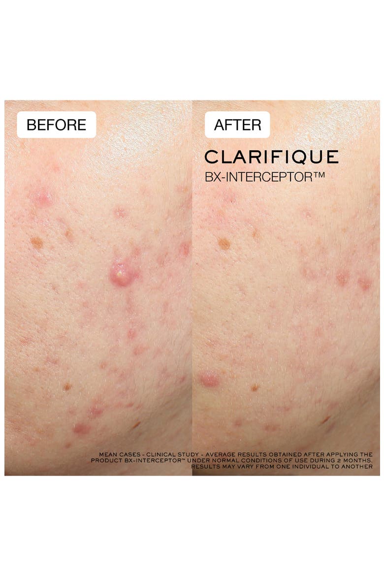 Clarifique Bx-Interceptor Acne Treatment with Glycolic & Salicylic Acid, Alternate, color, NO COLOR