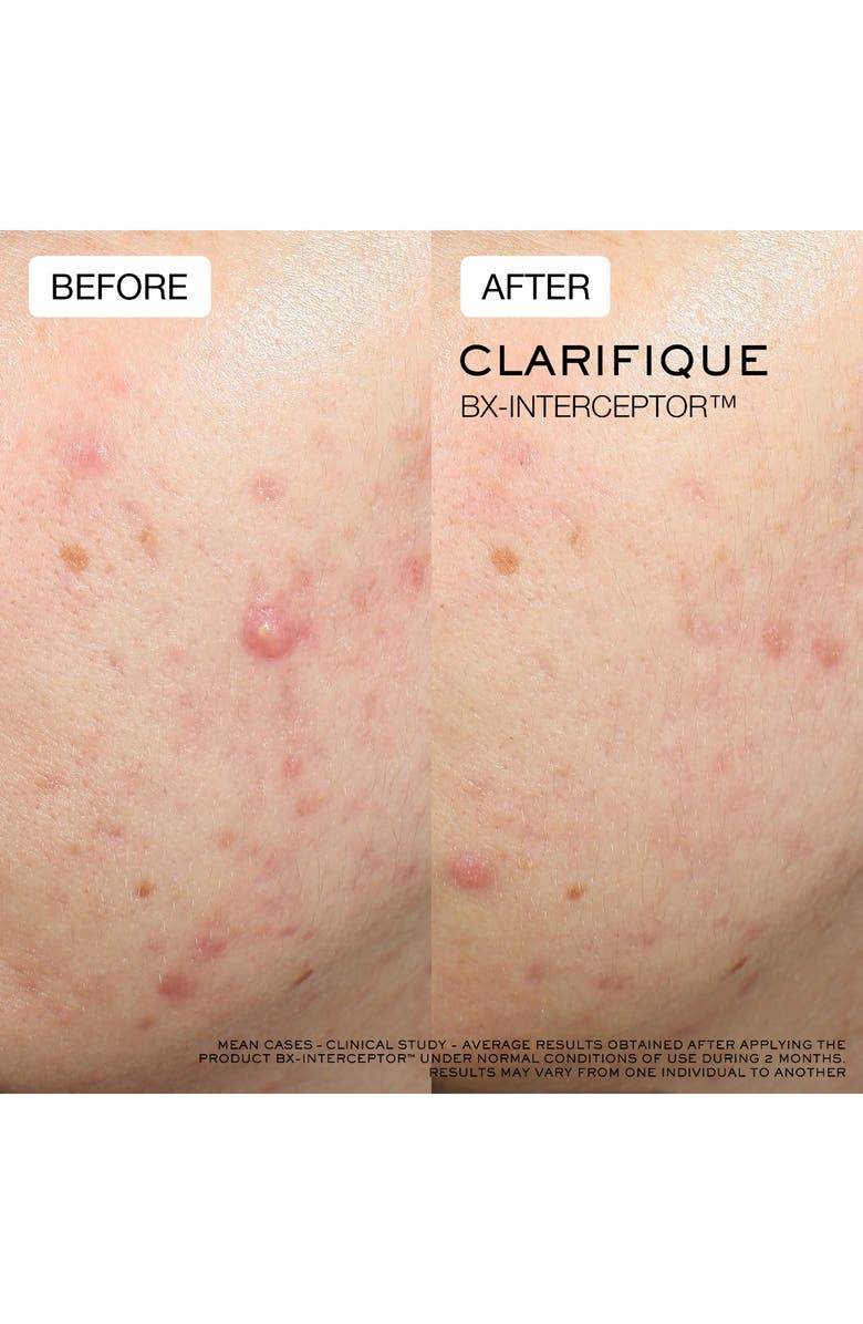 Lancôme Clarifique Bx-Interceptor Acne Treatment with Glycolic & Salicylic Acid, Alternate, color, 