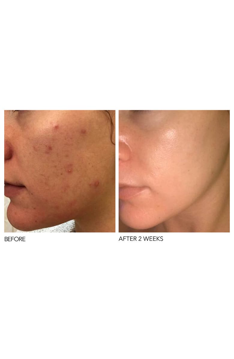 Dr. Dennis Gross Skincare Alpha Beta<sup>®</sup> Peel Extra Strength Formula, Alternate, color,