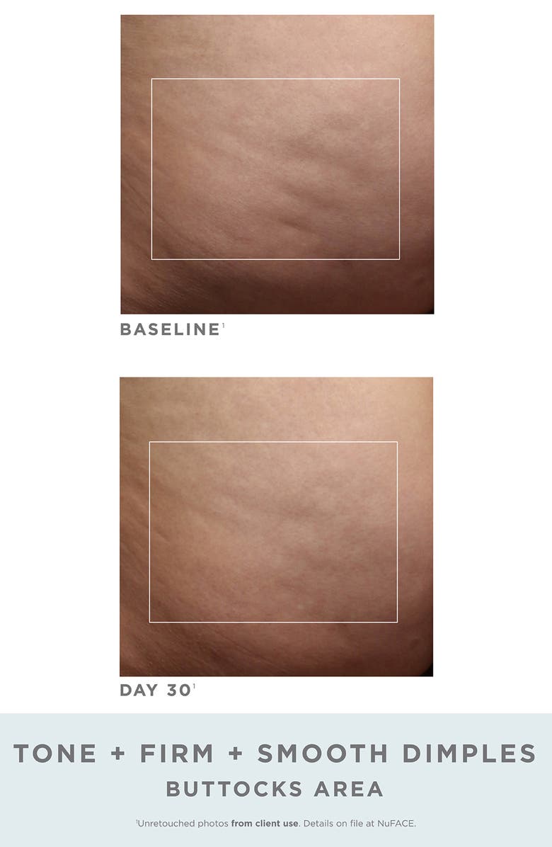 NuFACE<sup>®</sup> NuBODY Skin Toning Device Challenge Set, Alternate, color,