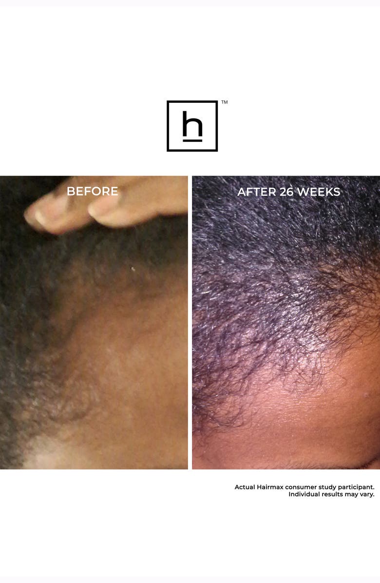 HAIRMAX<sup>®</sup> LaserBand 41 ComfortFlex Hair Growth Device, Alternate, color, Blue