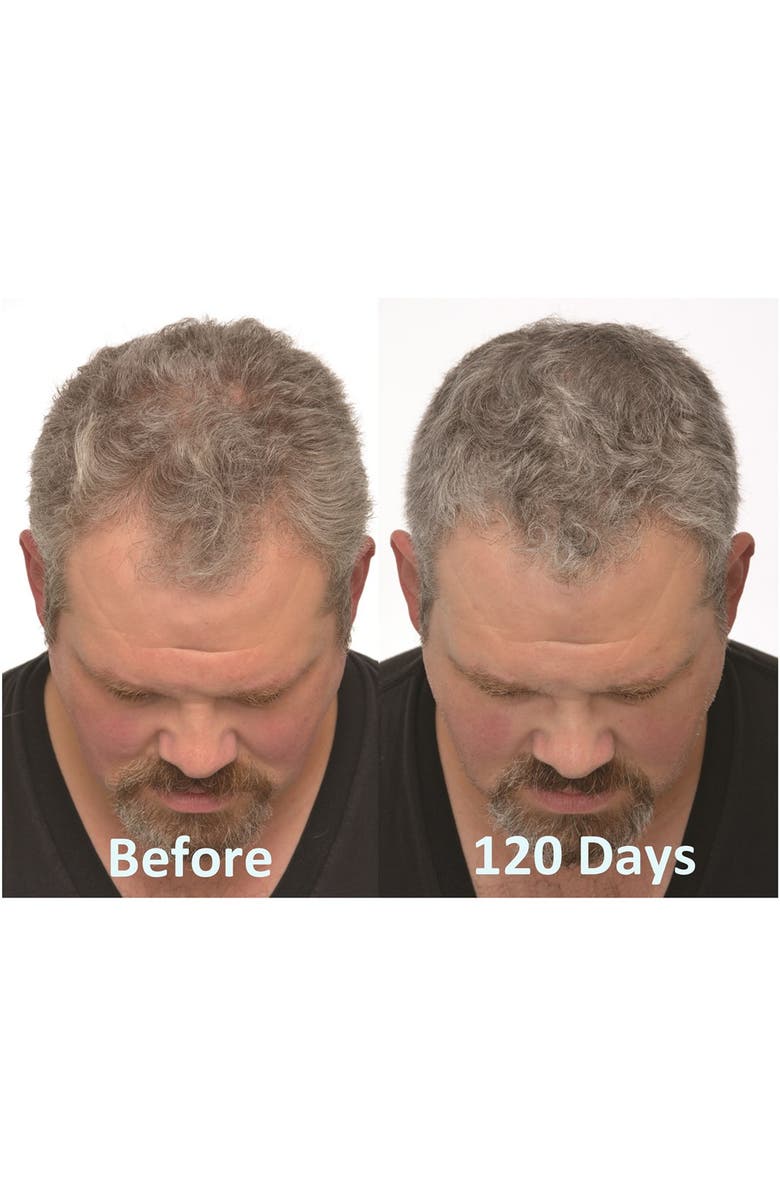 IGROW <sup>®</sup> Laser Hair Rejuvenation System, Alternate, color, 