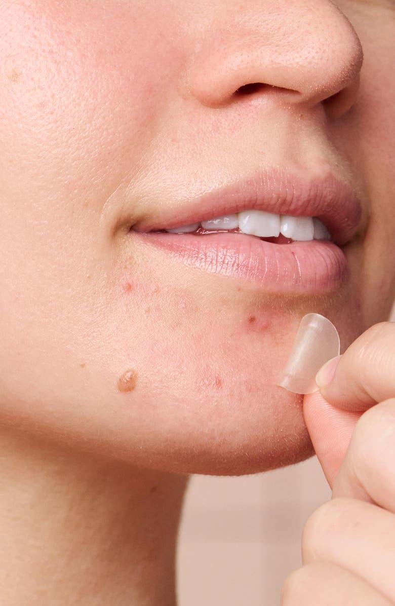 Hero Mighty Patch Micropoint<sup>™</sup> for Blemishes, Alternate, color,