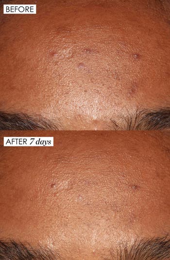 Good Genes All-in-One Lactic Acid Exfoliating Face Treatment Serum