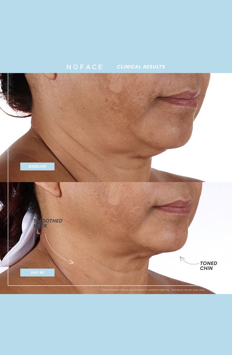 NuFACE<sup>®</sup> MINI+<sup>®</sup> Starter Kit $250 Value, Alternate, color,