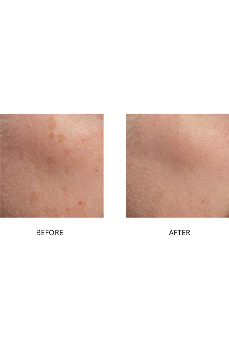 TRIA Beauty SmoothBeauty Laser, Alternate, color,