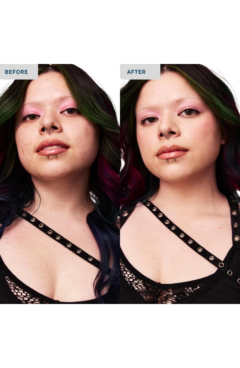 SPATCH Invisble Spot Fix, Alternate, color, Light To Medium Skin Tones