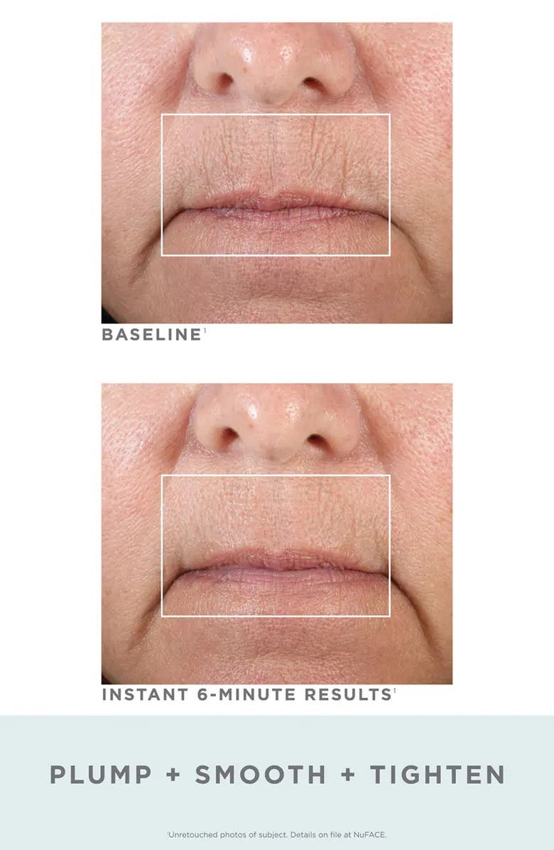 NuFACE<sup>®</sup> FIX<sup>®</sup> Mini Starter Kit, Alternate, color,