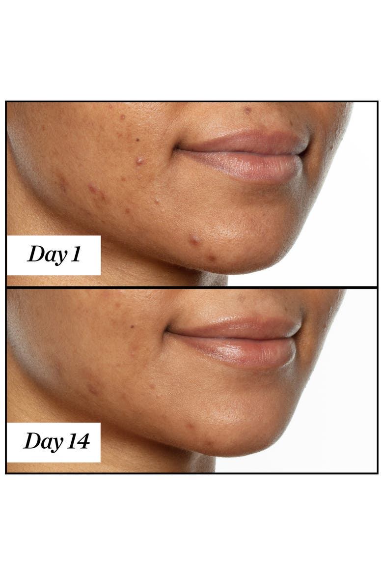 U.F.O. Ultra-Clarifying Acne Treatment Face Oil, Alternate, color, NO COLOR