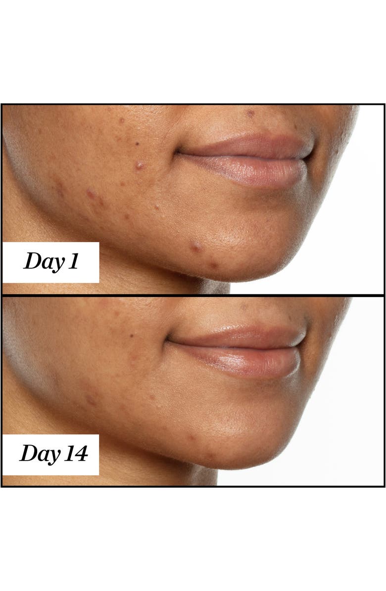 Sunday Riley U.F.O. Ultra-Clarifying Acne Treatment Face Oil, Alternate, color, 