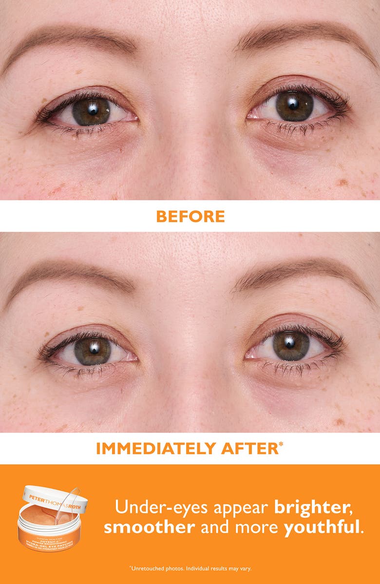 Vitamin C & Hyaluronic Eye Patches 2-Piece Kit $120 Value