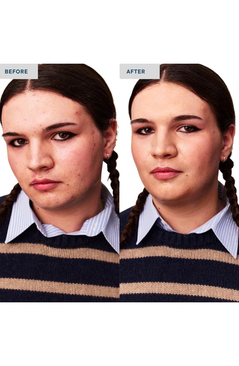 SPATCH Invisble Spot Fix, Alternate, color, Light To Medium Skin Tones