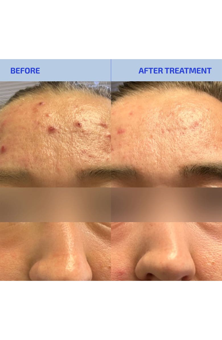 Codex Labs SHAANT Pore Purifying Acne Face Scrub, Alternate, color, Tan