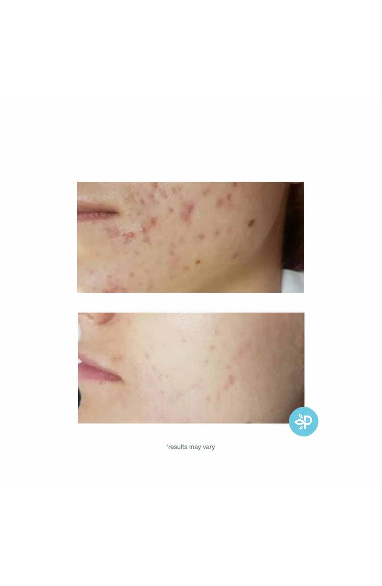 Perfect Image TCA 15% Skin Peel 1oz, Alternate, color, 