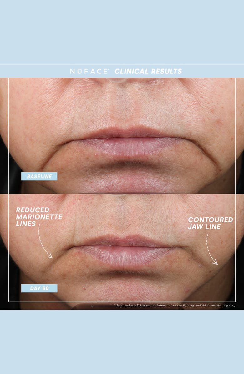 NuFACE<sup>®</sup> TRINITY+ Supercharged Skin Care Routine Set (Limited Edition) USD $509 Value, Alternate, color, 