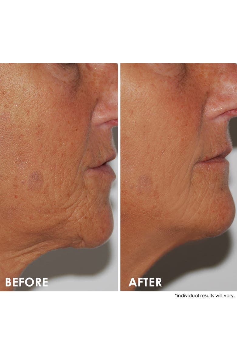 Dermelect SELF-ESTEEM Neck Firming Lift, Alternate, color, White