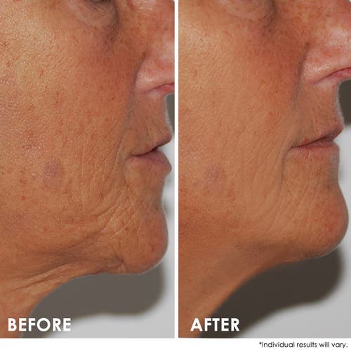 Dermelect Self-esteem Neck Firming Lift