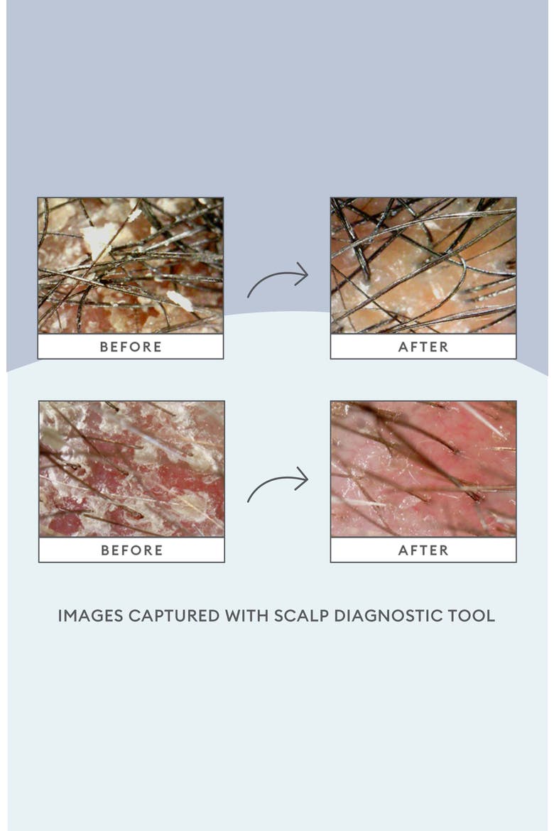 Scalp Saviors Set (Nordstrom Exclusive) $60 Value, Alternate, color, NO COLOR