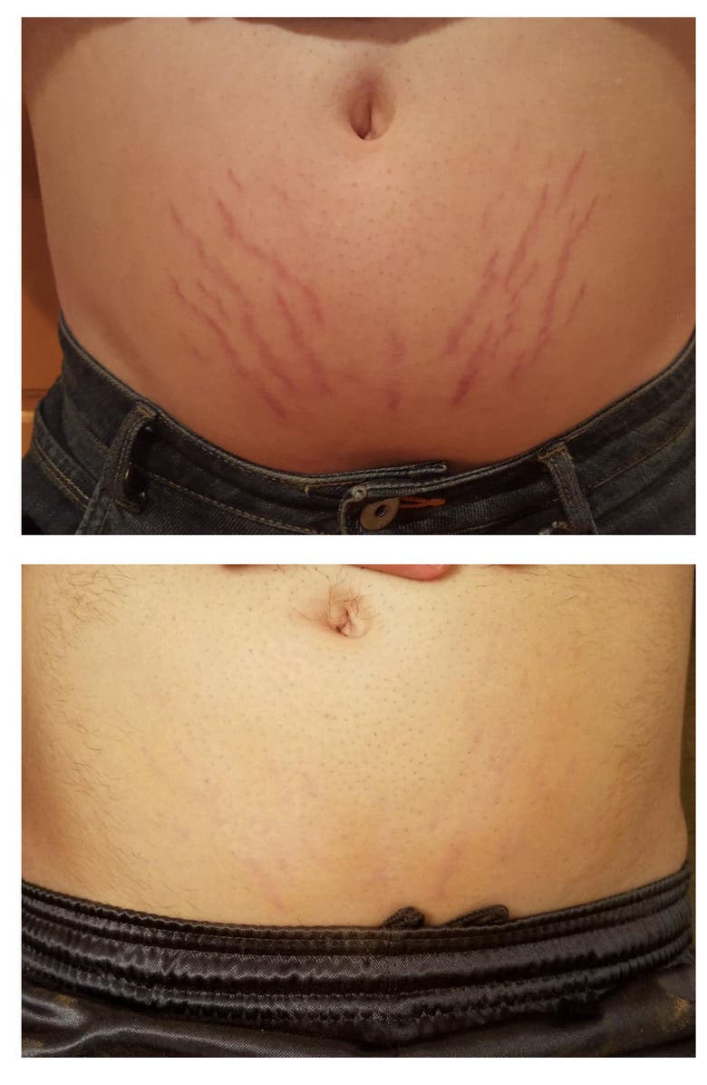 Strialite Stretch Mark LED Treatment Device, Alternate, color, 