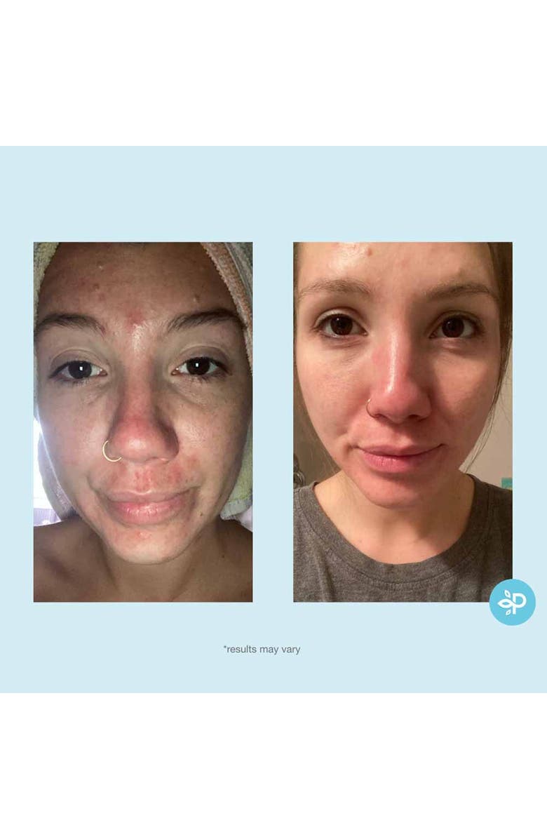 Perfect Image Glycolic 30% Gel Peel 1oz, Alternate, color, NO COLOR