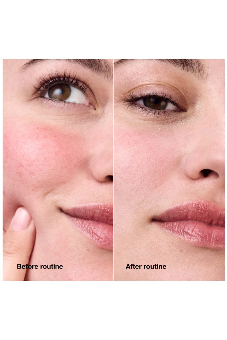 Redness Relief Kit, Alternate, color, NO COLOR