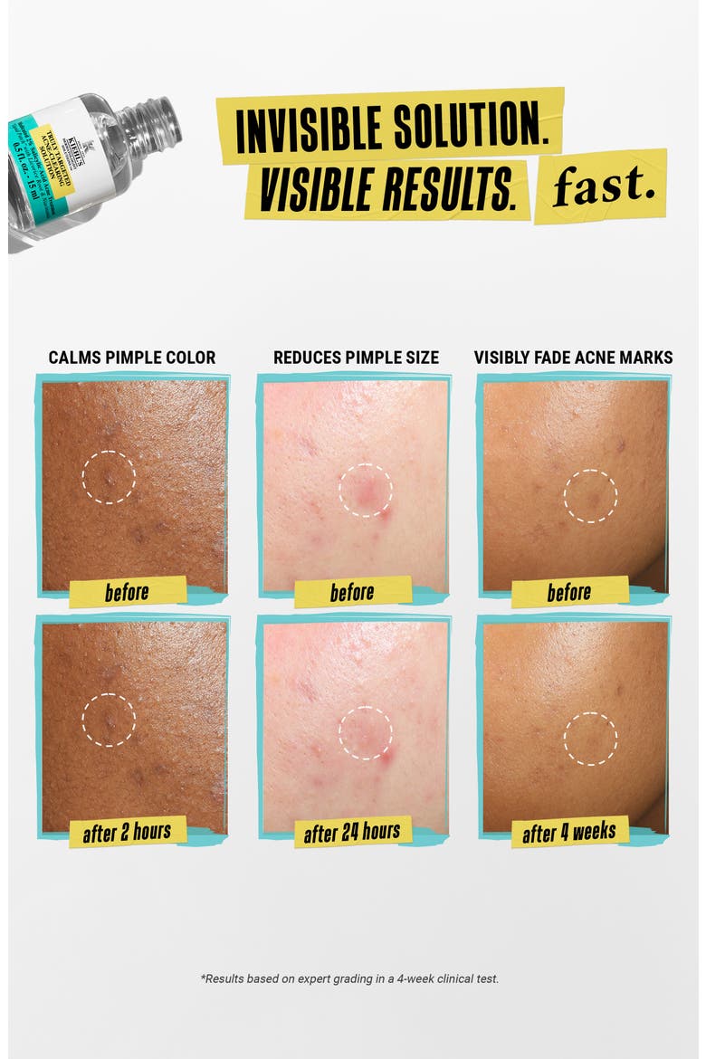 Truly Targeted Acne Clearing Solution, Alternate, color, NO COLOR