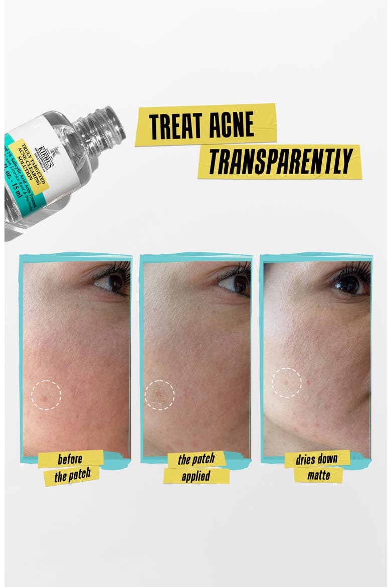 Truly Targeted Acne Clearing Solution, Alternate, color, NO COLOR
