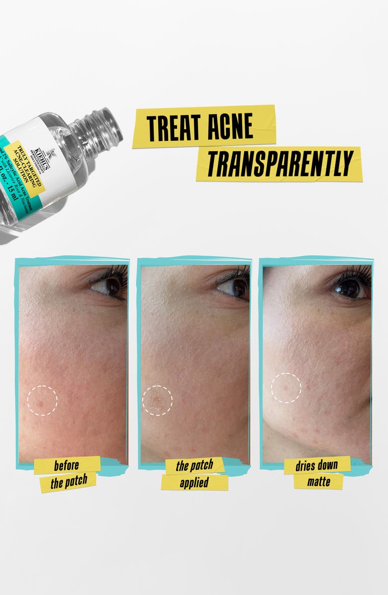 Kiehl's Since 1851 Truly Targeted Acne Clearing Solution, Alternate, color, 