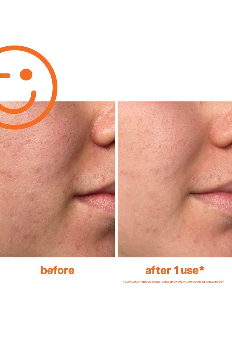 ExfoliKate<sup>®</sup> Intensive Exfoliating Treatment