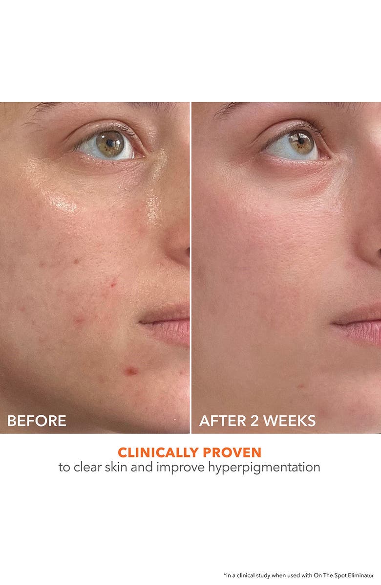 Dr. Dennis Gross Skincare Alpha Beta<sup>®</sup> 2% BHA+ Breakout Solution, Alternate, color, 