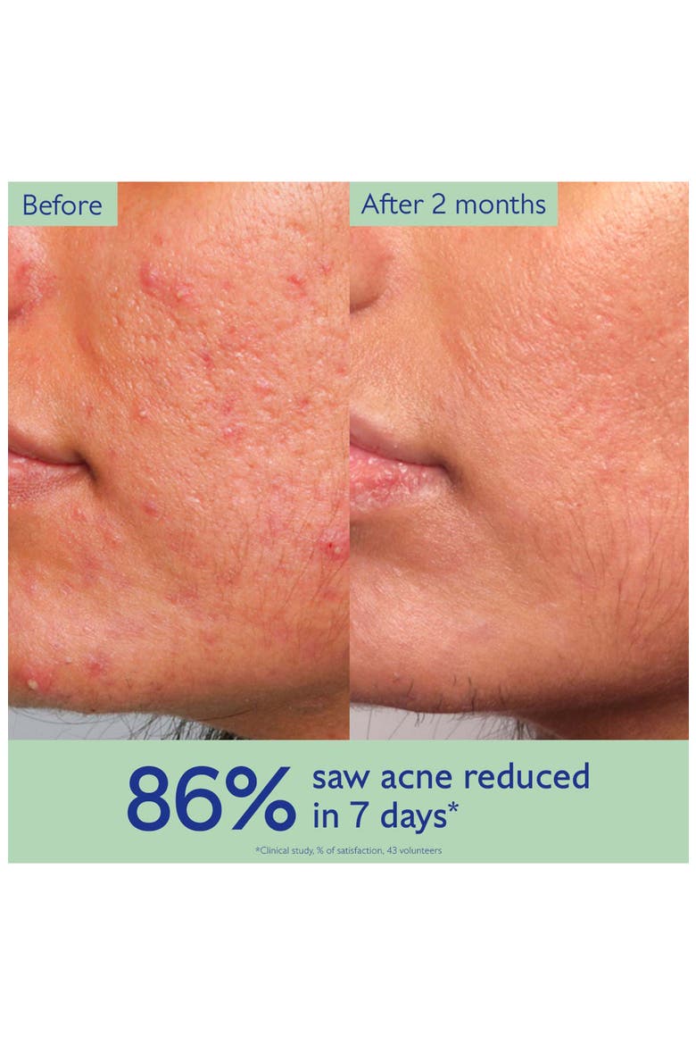 Vinopure Acne Serum, Alternate, color, NONE