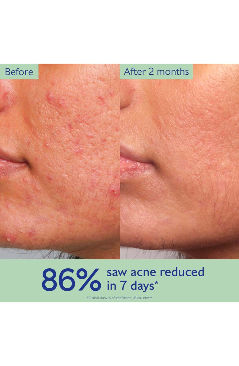 CAUDALÍE Vinopure Acne Serum, Alternate, color, 