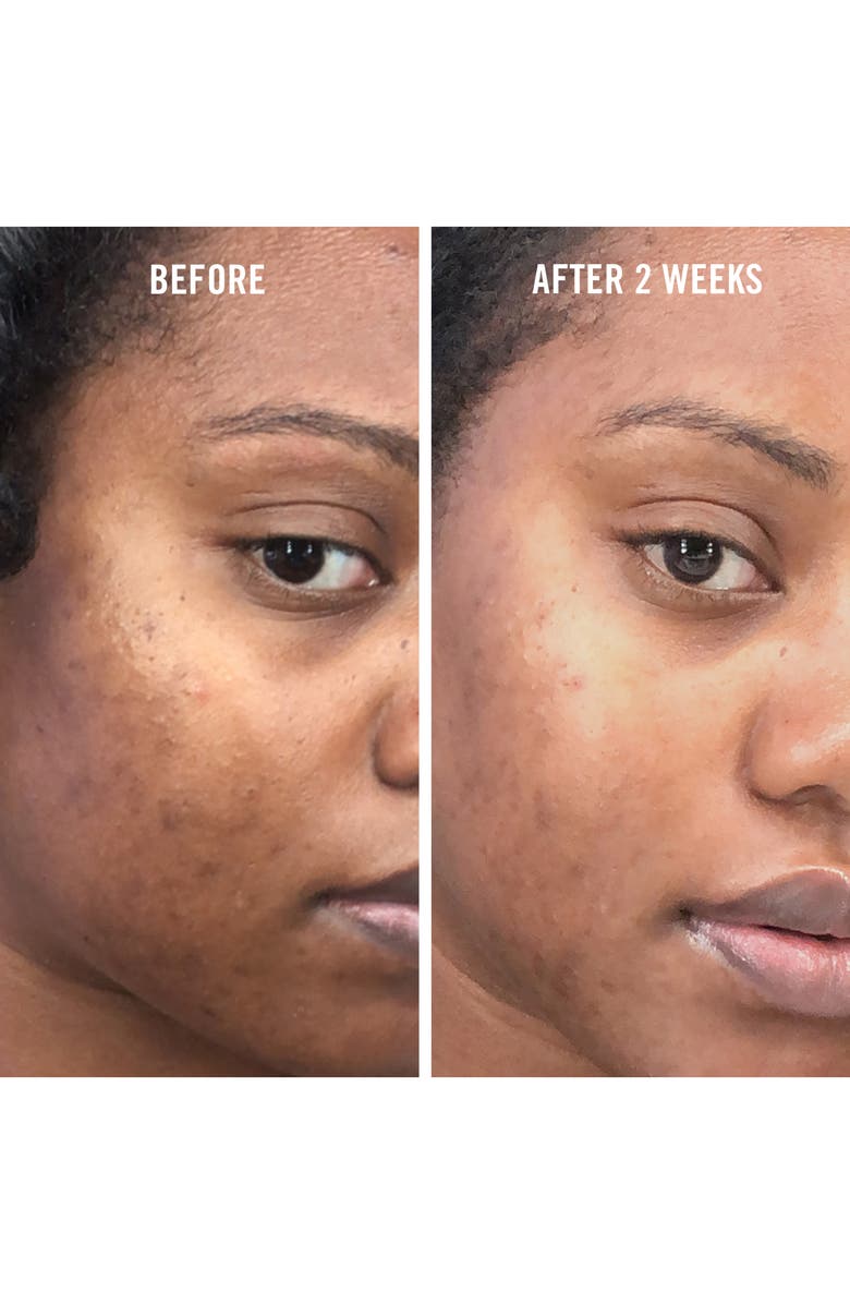 First Aid Beauty Facial Radiance Niacinamide Dark Spot Serum, Alternate, color,