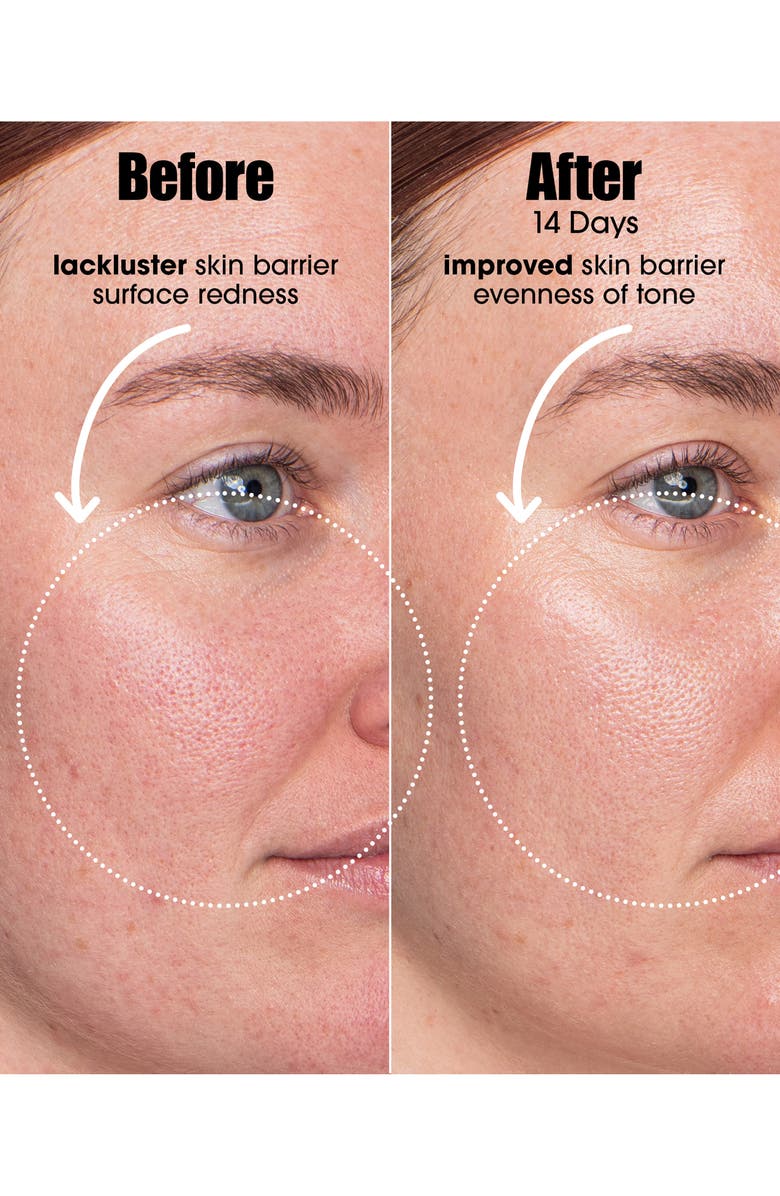 Sunday Riley AI Smart Retinoid Serum for Blemish-Prone Skin, Alternate, color, 