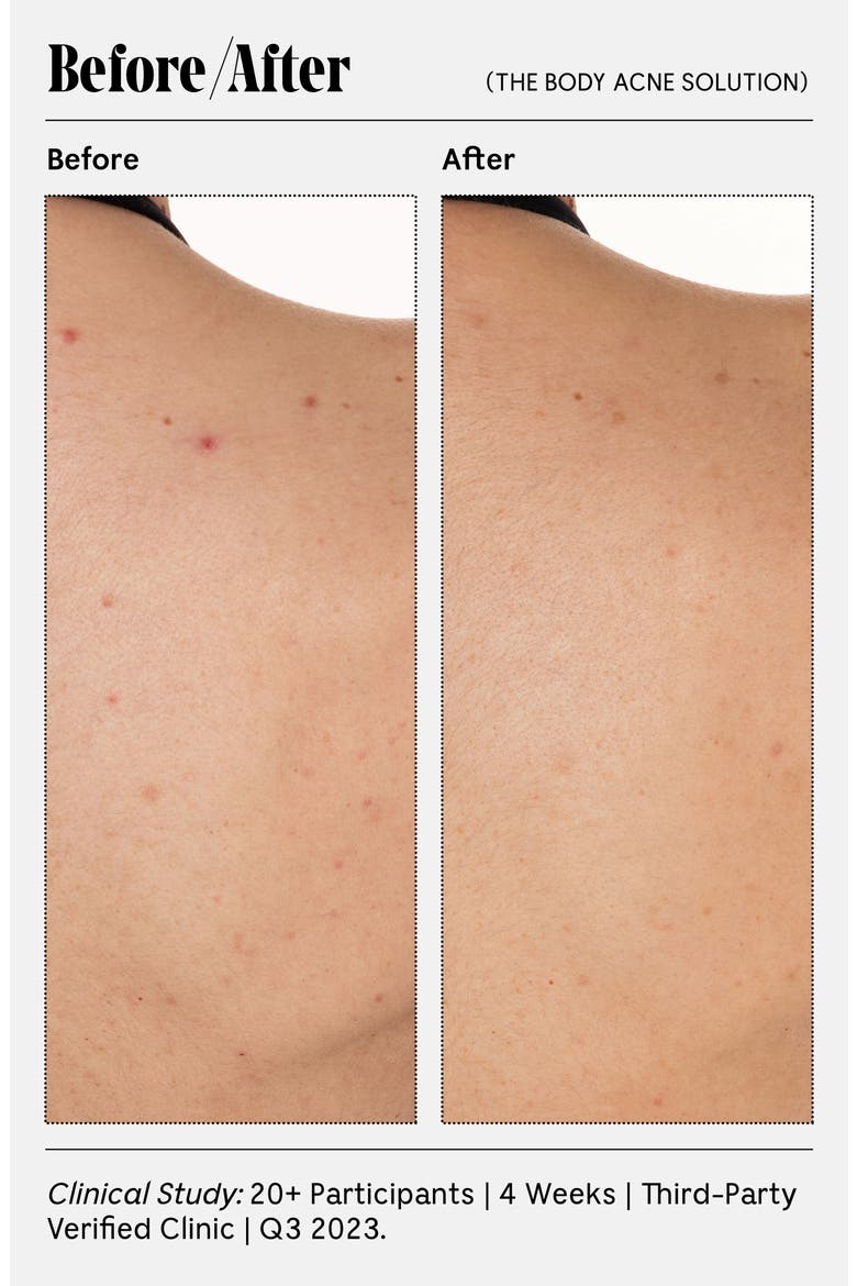 The Body Acne Solution, Alternate, color, NO COLOR