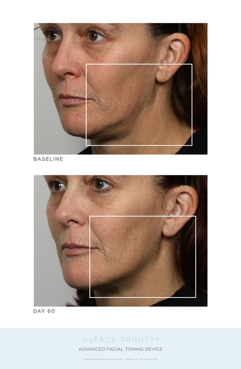 NuFACE<sup>®</sup> Trinity Advanced Lift Collection (Nordstrom Exclusive) USD $614 Value, Alternate, color,