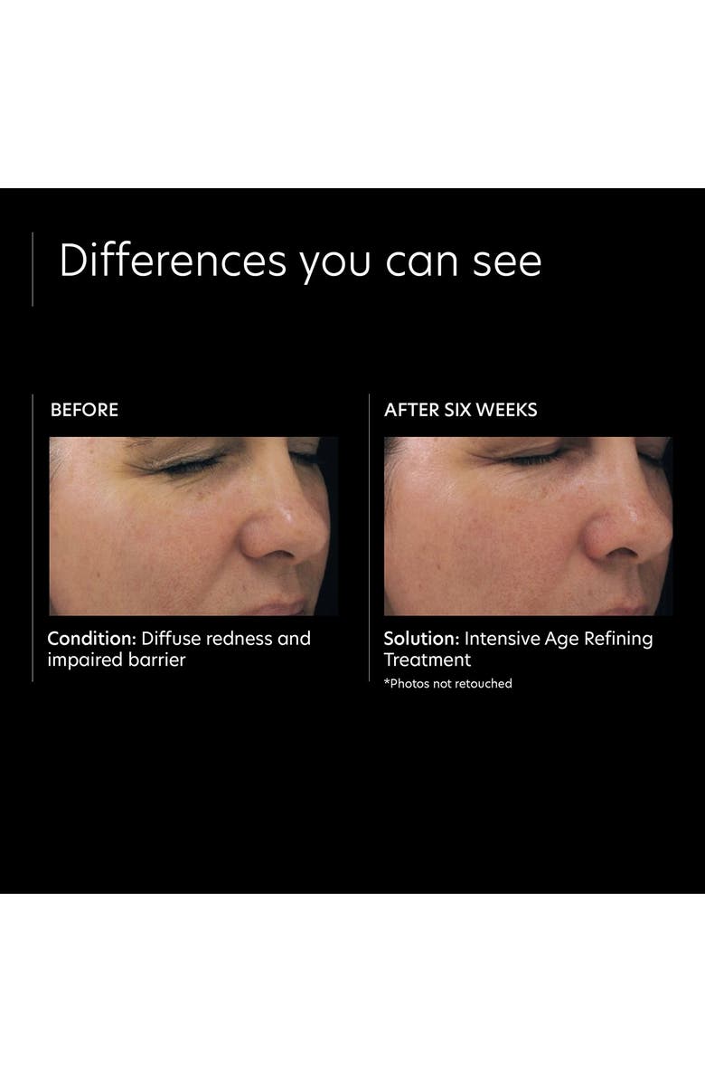 PCA Skin Intensive Age Refining Treatment, Alternate, color, 