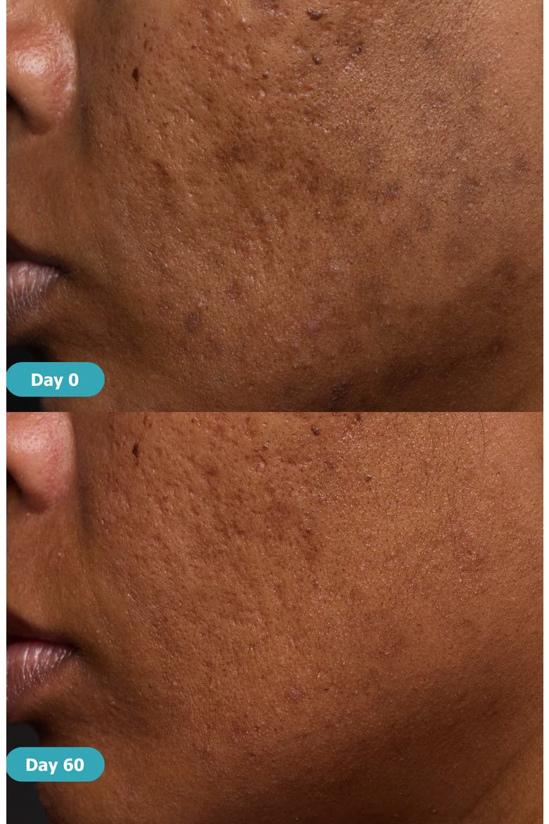 Lactic Acid Resurfacing Serum, Alternate, color, NO COLOR
