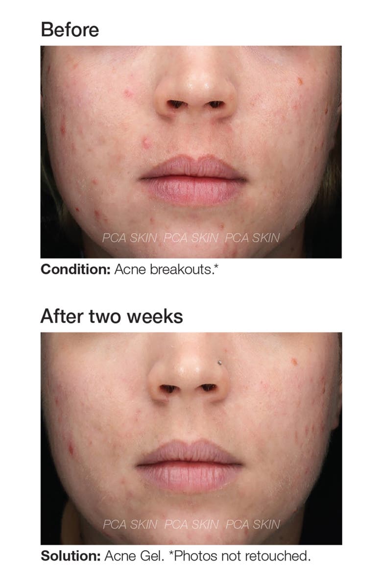 PCA Skin Acne Gel, Alternate, color, 