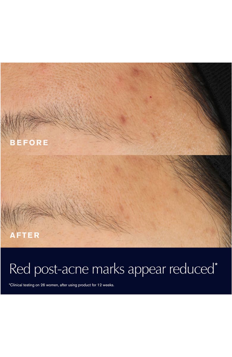 Estée Lauder Advanced Night Repair Rescue Solution Face Serum with 15% Bifidus Ferment, Alternate, color,