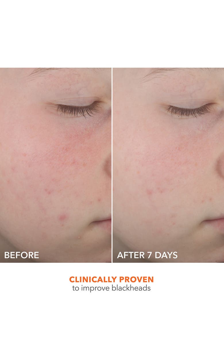 Dr. Dennis Gross Skincare Alpha Beta<sup>®</sup> On The Spot Eliminator, Alternate, color,