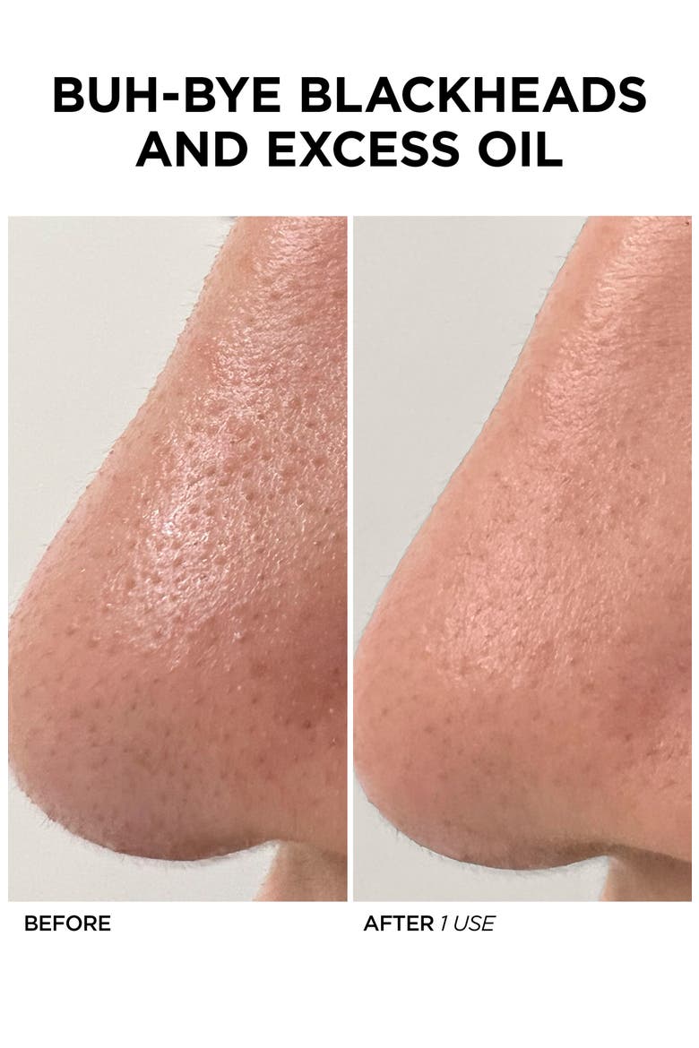 GLOfacial Hydro-Infusion Deep Pore Cleansing + Blue LED Clarifying Tool, Alternate, color, NO COLOR