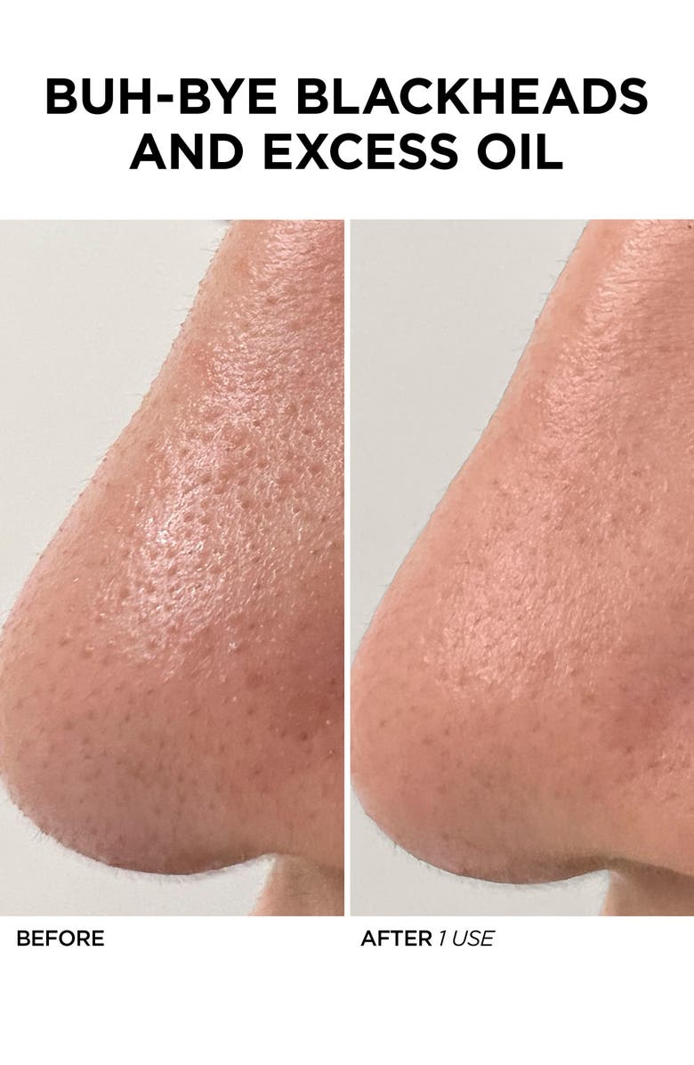 BeautyBio GLOfacial Hydro-Infusion Deep Pore Cleansing + Blue LED Clarifying Tool, Alternate, color, 